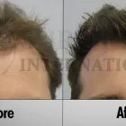 Entreprises 2 image SURE HAIR INTERNATIONAL Hair Loss Treatments & Clinics dans Toronto ON