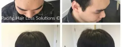 Entreprises 19 image PACIFIC HAIR LOSS SOLUTIONS Wigs & Hairpieces dans Vancouver BC