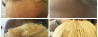 Entreprises 35 image PACIFIC HAIR LOSS SOLUTIONS Wigs & Hairpieces dans Vancouver BC