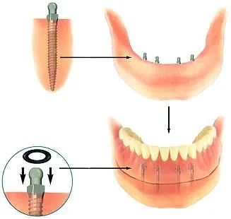 Entreprises 6 image MARCOUX DENTUROLOGISTE